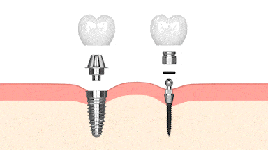 Mini Dental Implants in Winthrop, NY