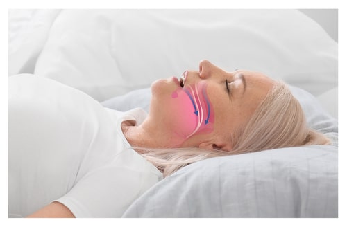 Obstructive sleep apnea is a common yet often underdiagnosed sleep disorder that can significantly impact your quality of life. At our dental practice in Winthrop, NY, we specialize in providing personalized, effective <yoastmark class=