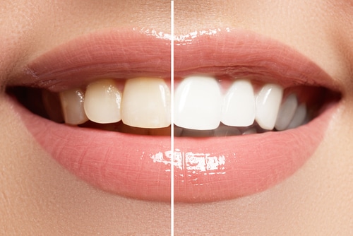 Teeth Whitening in Winthrop, NY Michael T. Guldan, DDS